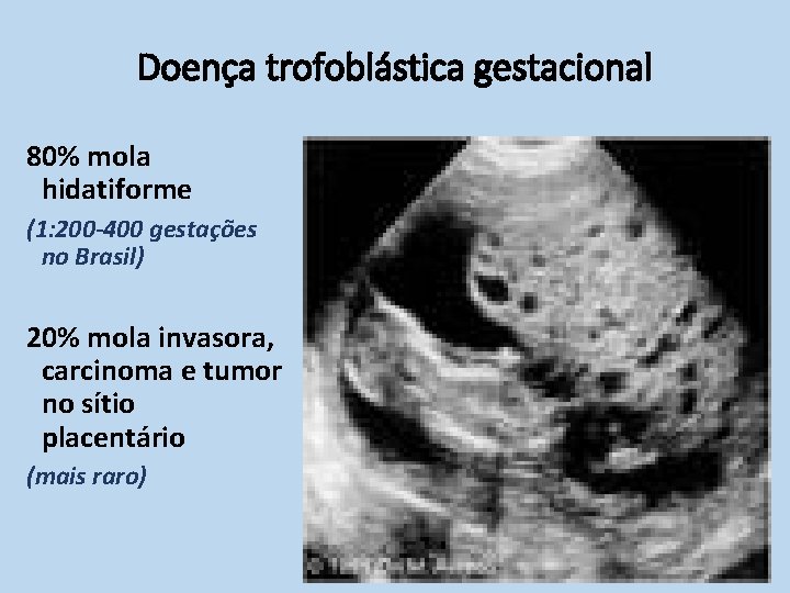 Doença trofoblástica gestacional 80% mola hidatiforme (1: 200 -400 gestações no Brasil) 20% mola