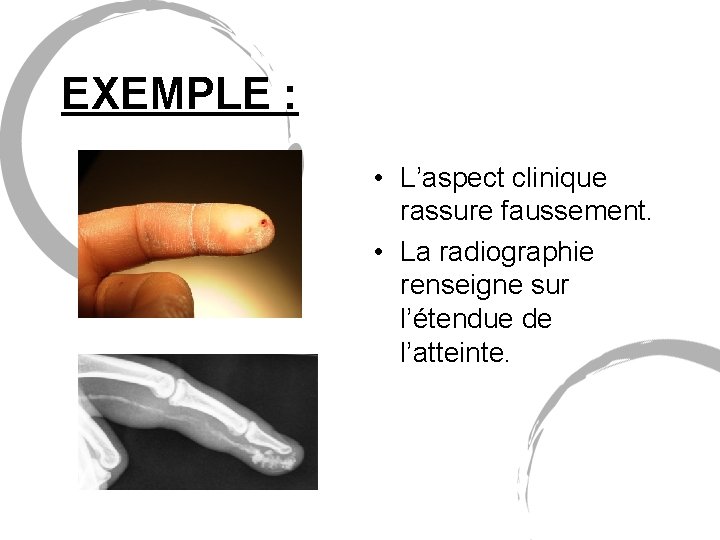 EXEMPLE : • L’aspect clinique rassure faussement. • La radiographie renseigne sur l’étendue de