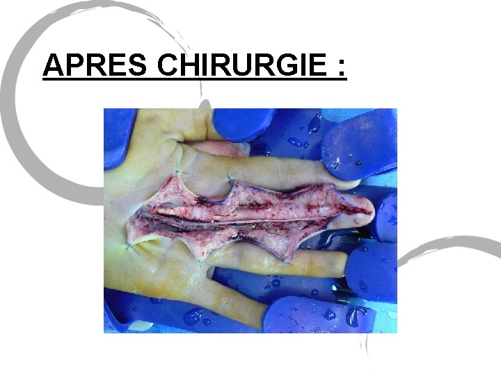 APRES CHIRURGIE : 