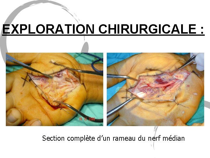 EXPLORATION CHIRURGICALE : Section complète d’un rameau du nerf médian 