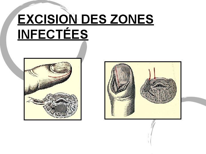 EXCISION DES ZONES INFECTÉES 
