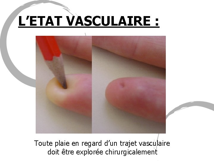L’ETAT VASCULAIRE : Toute plaie en regard d’un trajet vasculaire doit être explorée chirurgicalement