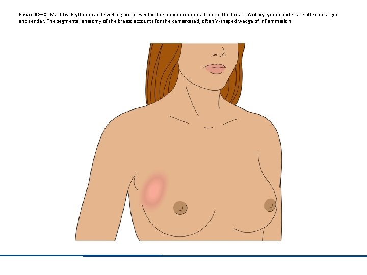 Figure 38– 2 Mastitis. Erythema and swelling are present in the upper outer quadrant