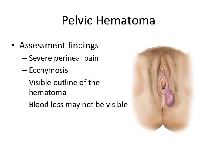 Pelvic Hematoma • Assessment findings – Severe perineal pain – Ecchymosis – Visible outline