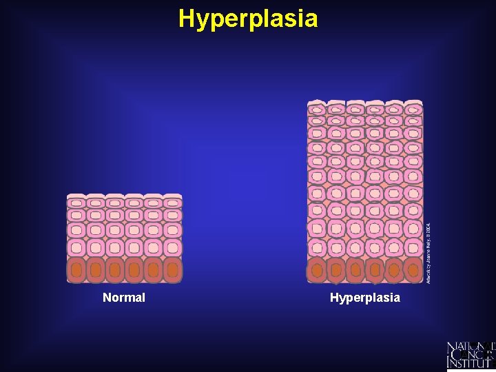 Hyperplasia Normal Hyperplasia 