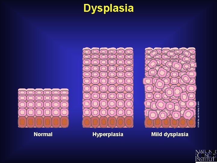 Dysplasia Normal Hyperplasia Mild dysplasia 