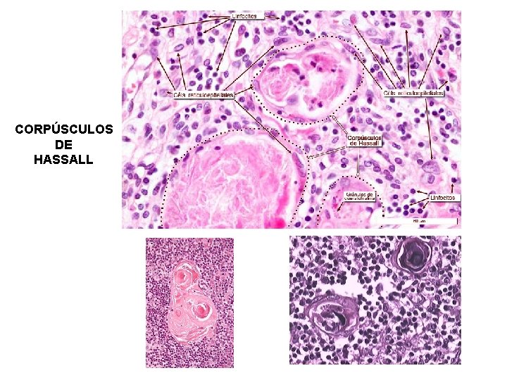 CORPÚSCULOS DE HASSALL 