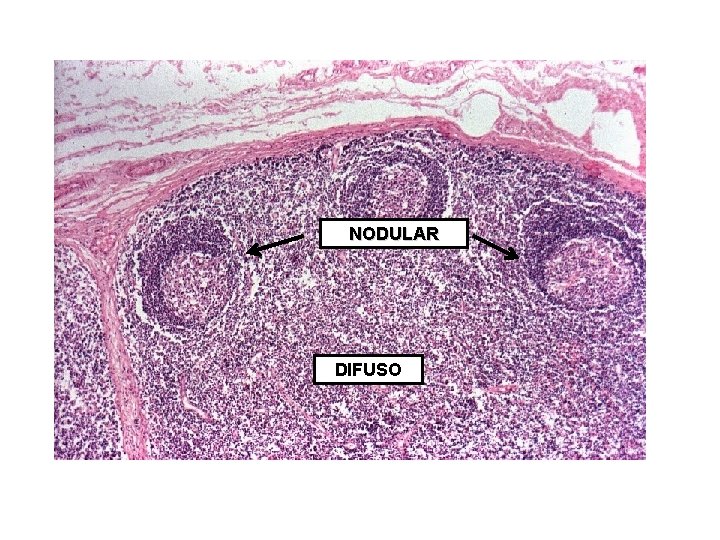 NODULAR DIFUSO 