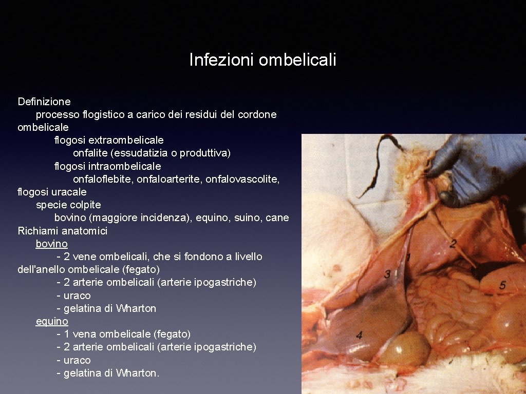 Infezioni ombelicali Definizione processo flogistico a carico dei residui del cordone ombelicale flogosi extraombelicale