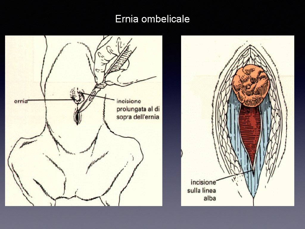 Ernia ombelicale 