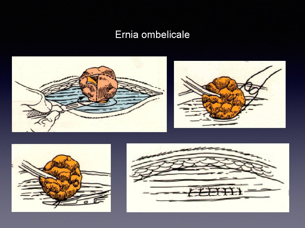 Ernia ombelicale 