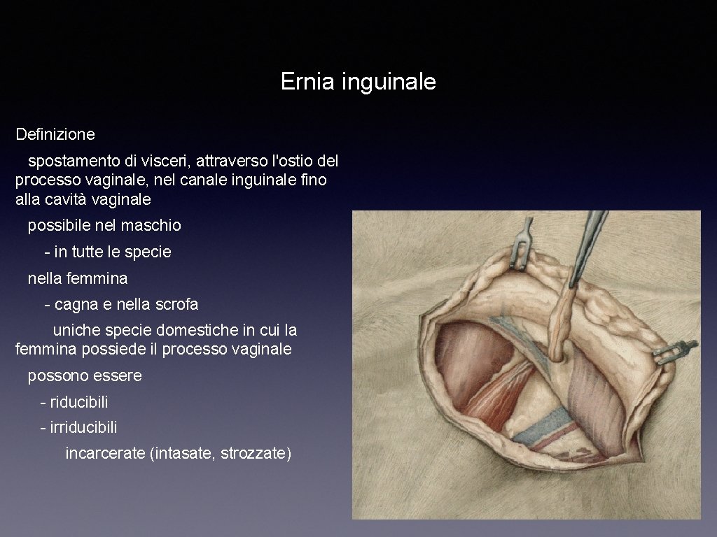 Ernia inguinale Definizione spostamento di visceri, attraverso l'ostio del processo vaginale, nel canale inguinale