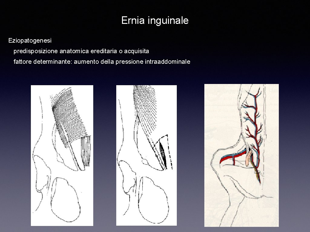 Ernia inguinale Eziopatogenesi predisposizione anatomica ereditaria o acquisita fattore determinante: aumento della pressione intraaddominale