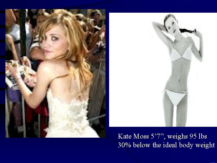 Kate Moss 5’ 7”, weighs 95 lbs 30% below the ideal body weight 