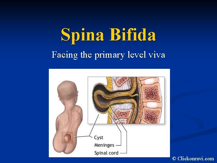 Spina Bifida Facing the primary level viva © Clickonravi. com 