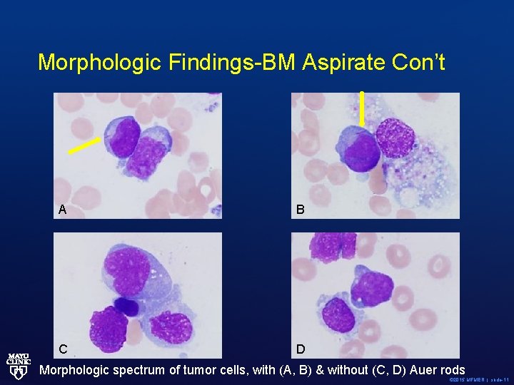 Morphologic Findings-BM Aspirate Con’t A B C D Morphologic spectrum of tumor cells, with