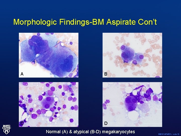 Morphologic Findings-BM Aspirate Con’t A B C D Normal (A) & atypical (B-D) megakaryocytes