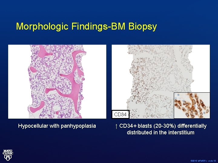 Morphologic Findings-BM Biopsy CD 34 Hypocellular with panhypoplasia ↑ CD 34+ blasts (20 -30%)