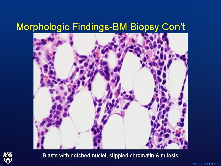 Morphologic Findings-BM Biopsy Con’t Blasts with notched nuclei, stippled chromatin & mitosis © 2015