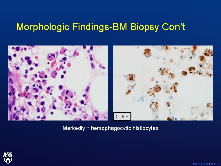 Morphologic Findings-BM Biopsy Con’t CD 68 Markedly ↑ hemophagocytic histiocytes © 2015 MFMER |