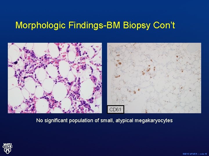 Morphologic Findings-BM Biopsy Con’t CD 61 No significant population of small, atypical megakaryocytes ©