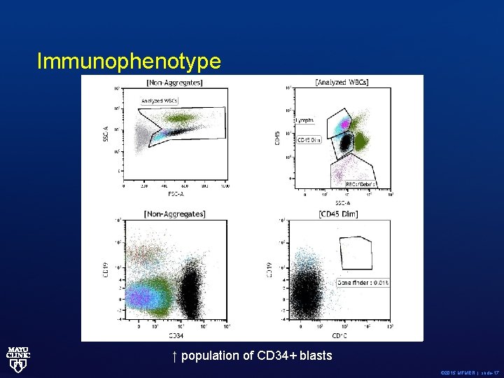 Immunophenotype ↑ population of CD 34+ blasts © 2015 MFMER | slide-17 