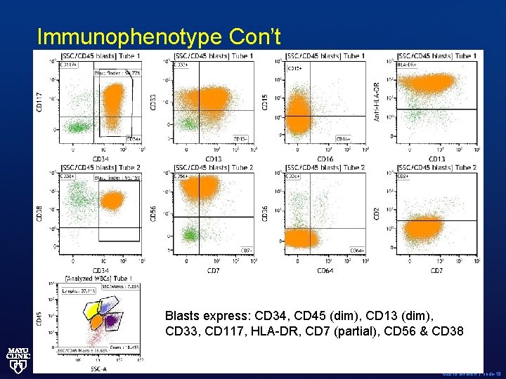 Immunophenotype Con’t Blasts express: CD 34, CD 45 (dim), CD 13 (dim), CD 33,