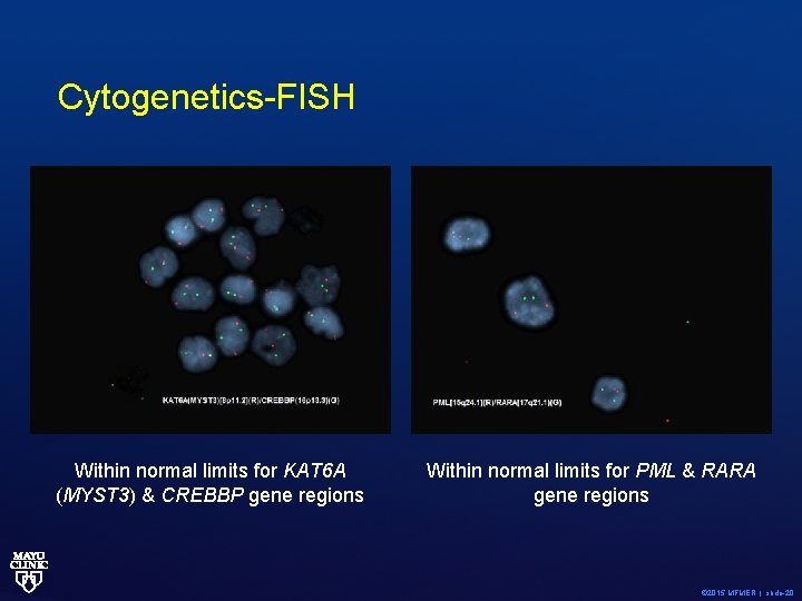 Cytogenetics-FISH Within normal limits for KAT 6 A (MYST 3) & CREBBP gene regions