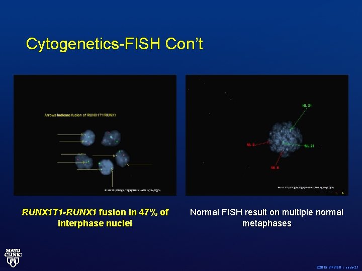 Cytogenetics-FISH Con’t RUNX 1 T 1 -RUNX 1 fusion in 47% of interphase nuclei