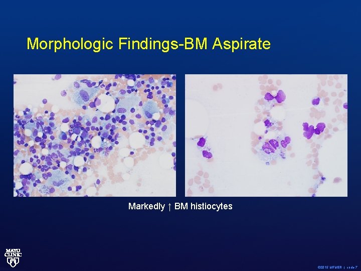 Morphologic Findings-BM Aspirate Markedly ↑ BM histiocytes © 2015 MFMER | slide-7 