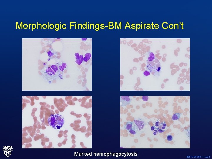 Morphologic Findings-BM Aspirate Con’t Marked hemophagocytosis © 2015 MFMER | slide-8 