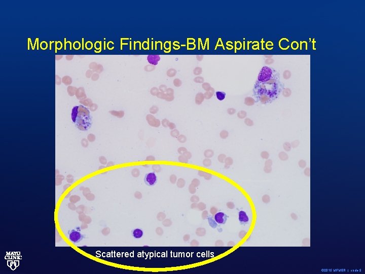 Morphologic Findings-BM Aspirate Con’t Scattered atypical tumor cells © 2015 MFMER | slide-9 