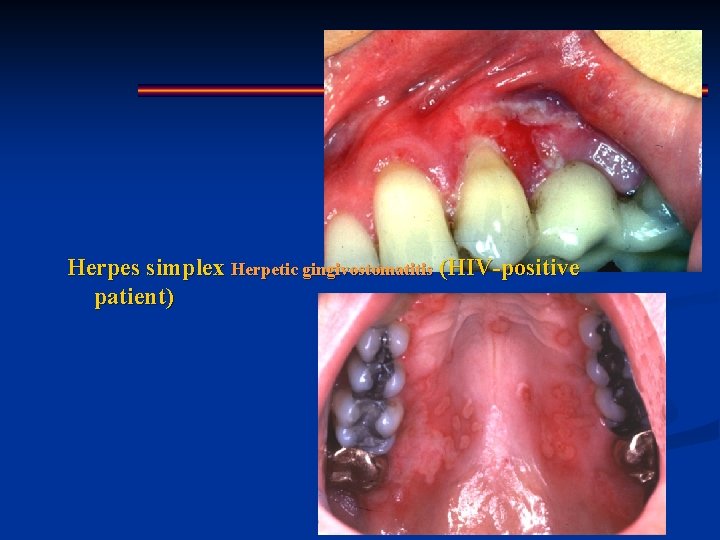Herpes simplex Herpetic gingivostomatitis (HIV-positive patient) 
