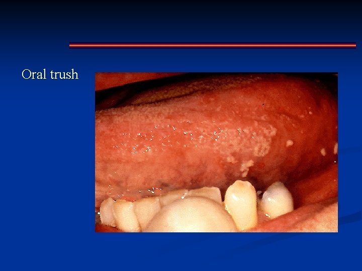 Oral trush 