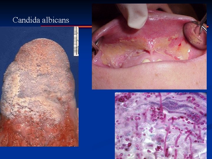 Candida albicans 
