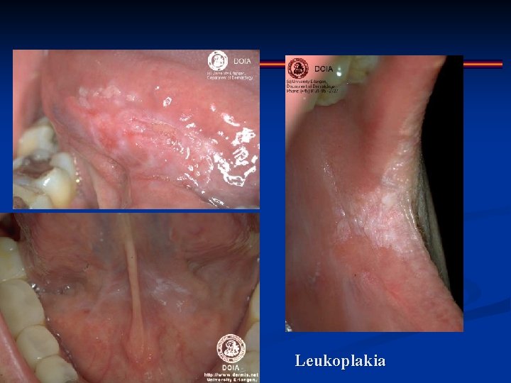 Leukoplakia 