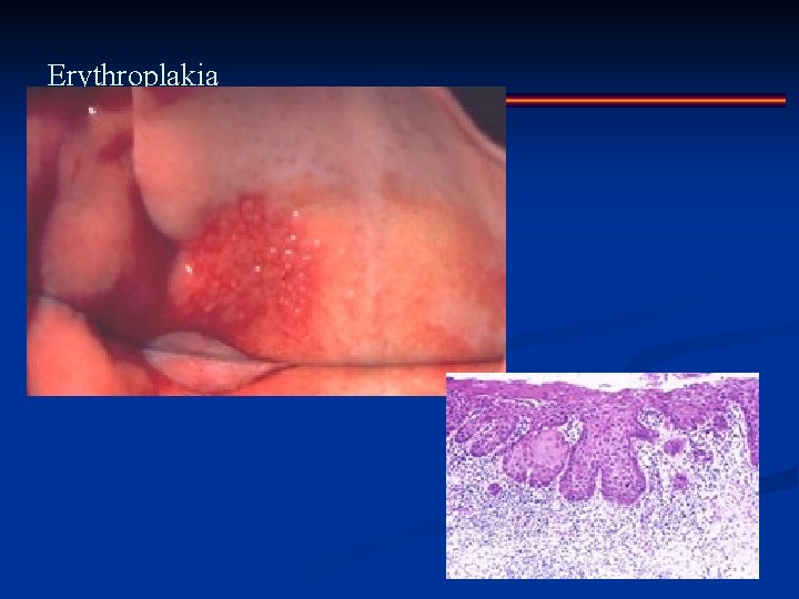 Erythroplakia 