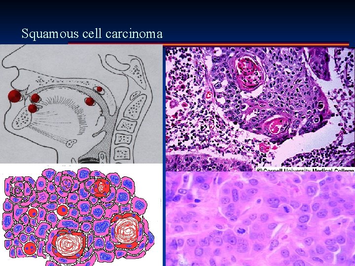 Squamous cell carcinoma 