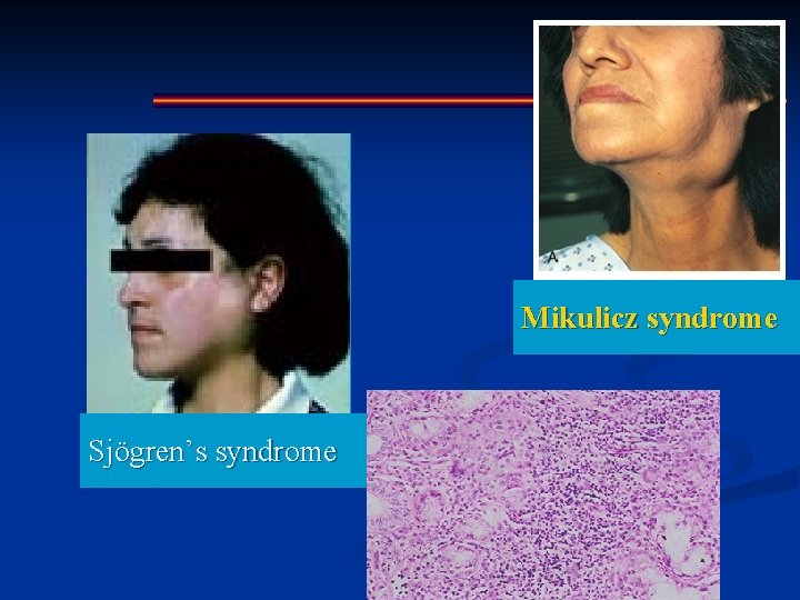 Mikulicz syndrome Sjögren’s syndrome 