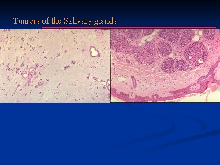 Tumors of the Salivary glands 