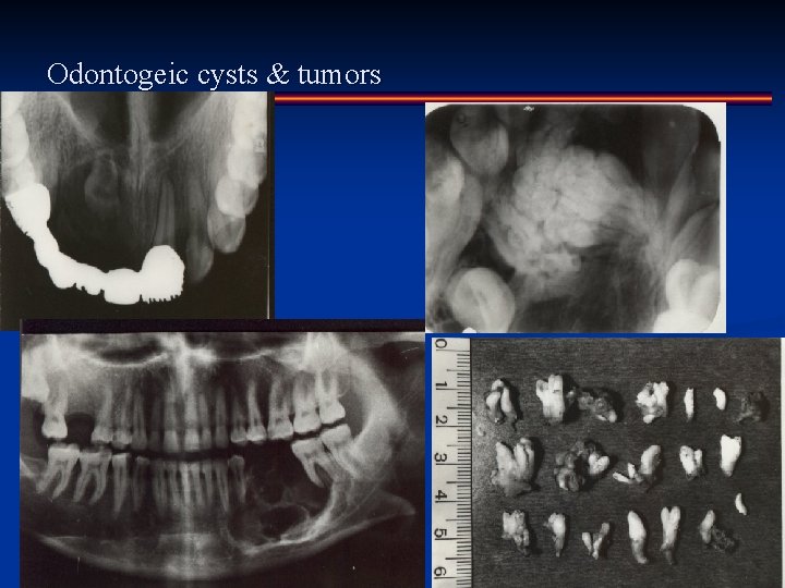 Odontogeic cysts & tumors 