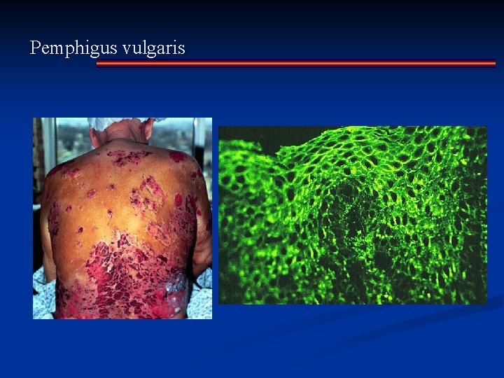 Pemphigus vulgaris 
