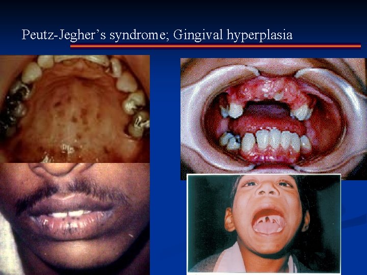 Peutz-Jegher’s syndrome; Gingival hyperplasia 