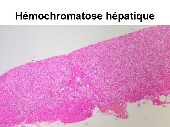 Hémochromatose hépatique 