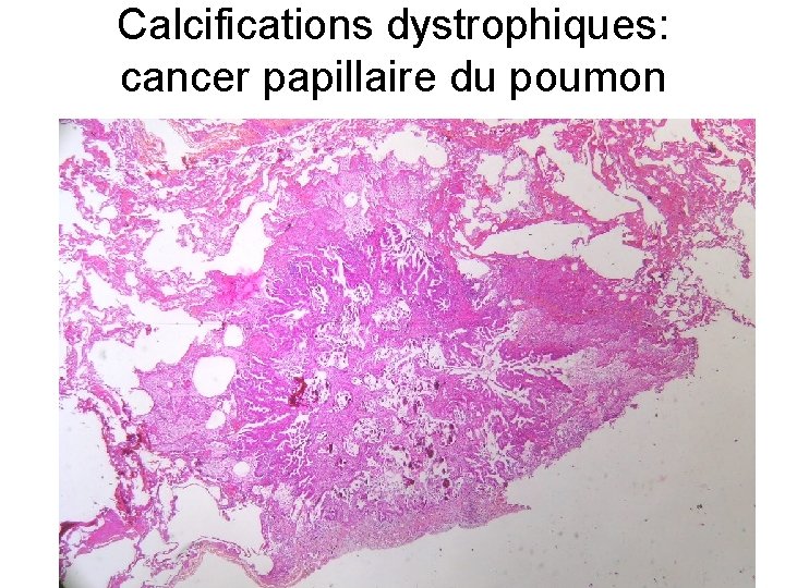 Calcifications dystrophiques: cancer papillaire du poumon 