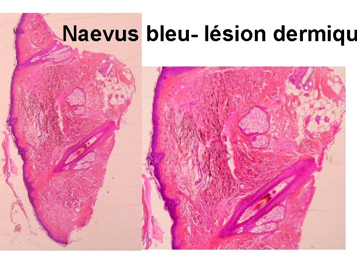Naevus bleu- lésion dermiqu 