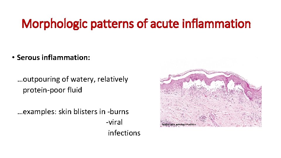 Morphologic patterns of acute inflammation • Serous inflammation: …outpouring of watery, relatively protein-poor fluid