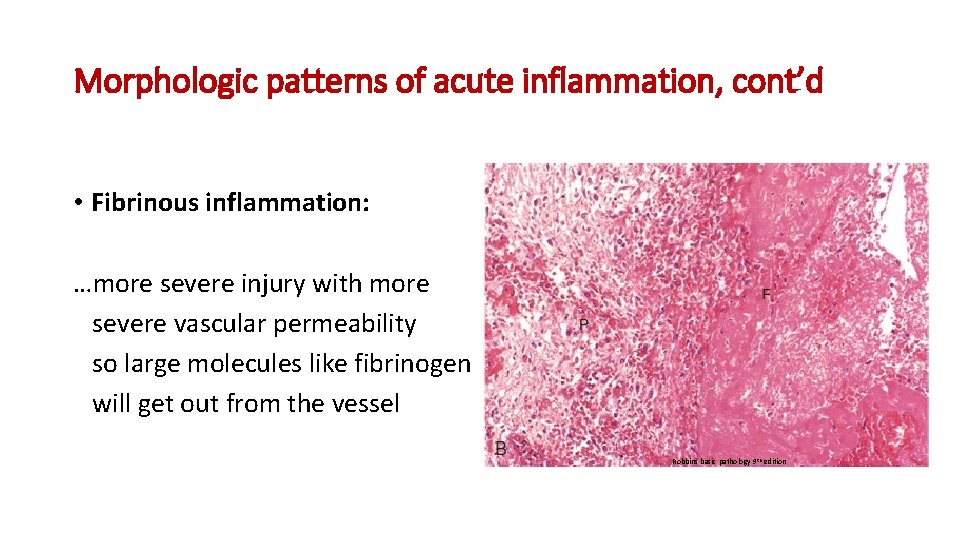 Morphologic patterns of acute inflammation, cont’d • Fibrinous inflammation: …more severe injury with more