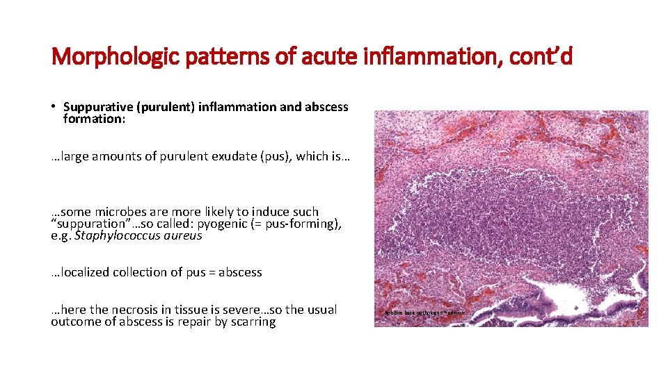 Morphologic patterns of acute inflammation, cont’d • Suppurative (purulent) inflammation and abscess formation: …large