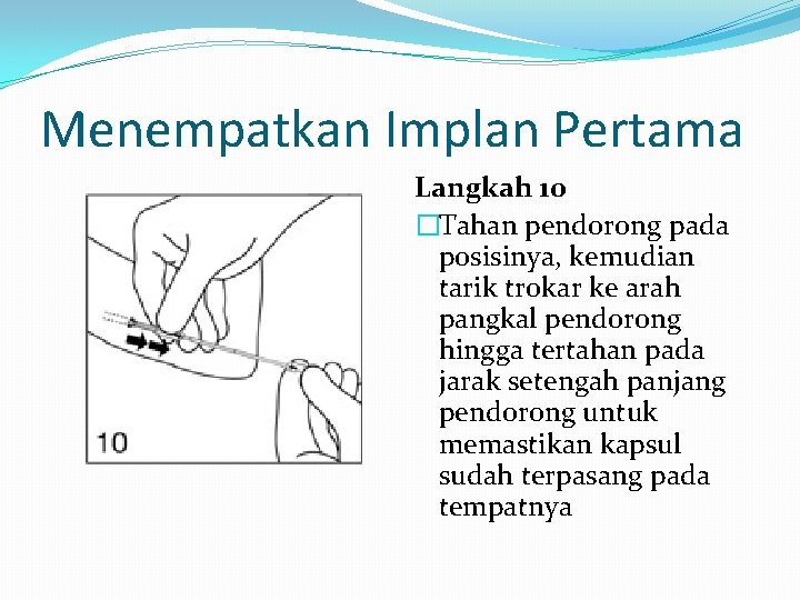 Menempatkan Implan Pertama Langkah 10 �Tahan pendorong pada posisinya, kemudian tarik trokar ke arah